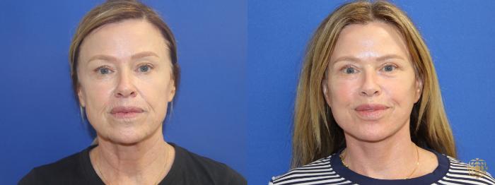 Before & After Facial Fat Grafting Case 416 Front View in Newport Beach, CA