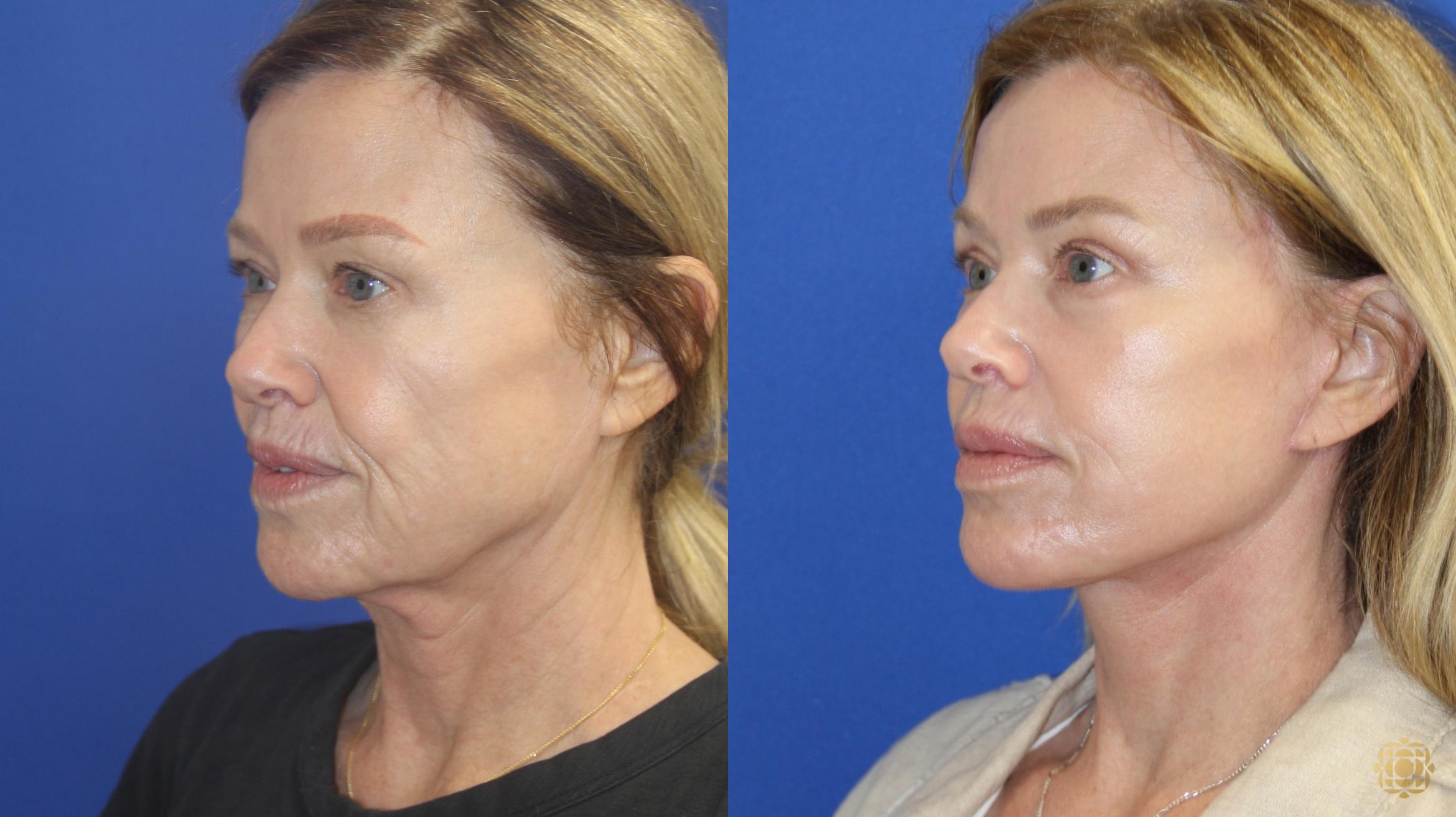 Before & After Dr. Daines Signature Facelift Case 416 Left Oblique View in Newport Beach, CA