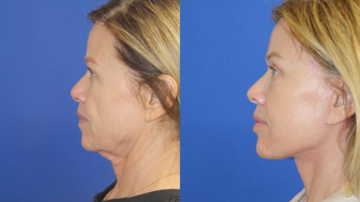 Before & After Dr. Daines Signature Facelift Case 416 Left Side View in Newport Beach, CA