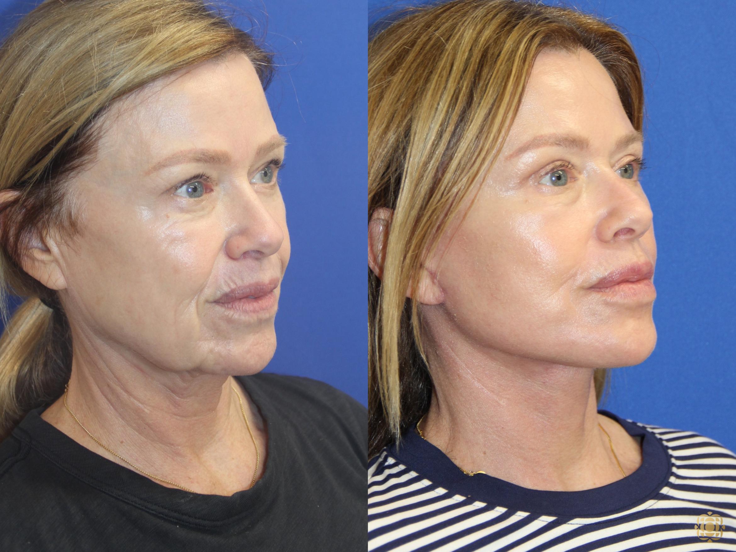 Before & After Facial Fat Grafting Case 416 Right Oblique View in Newport Beach, CA