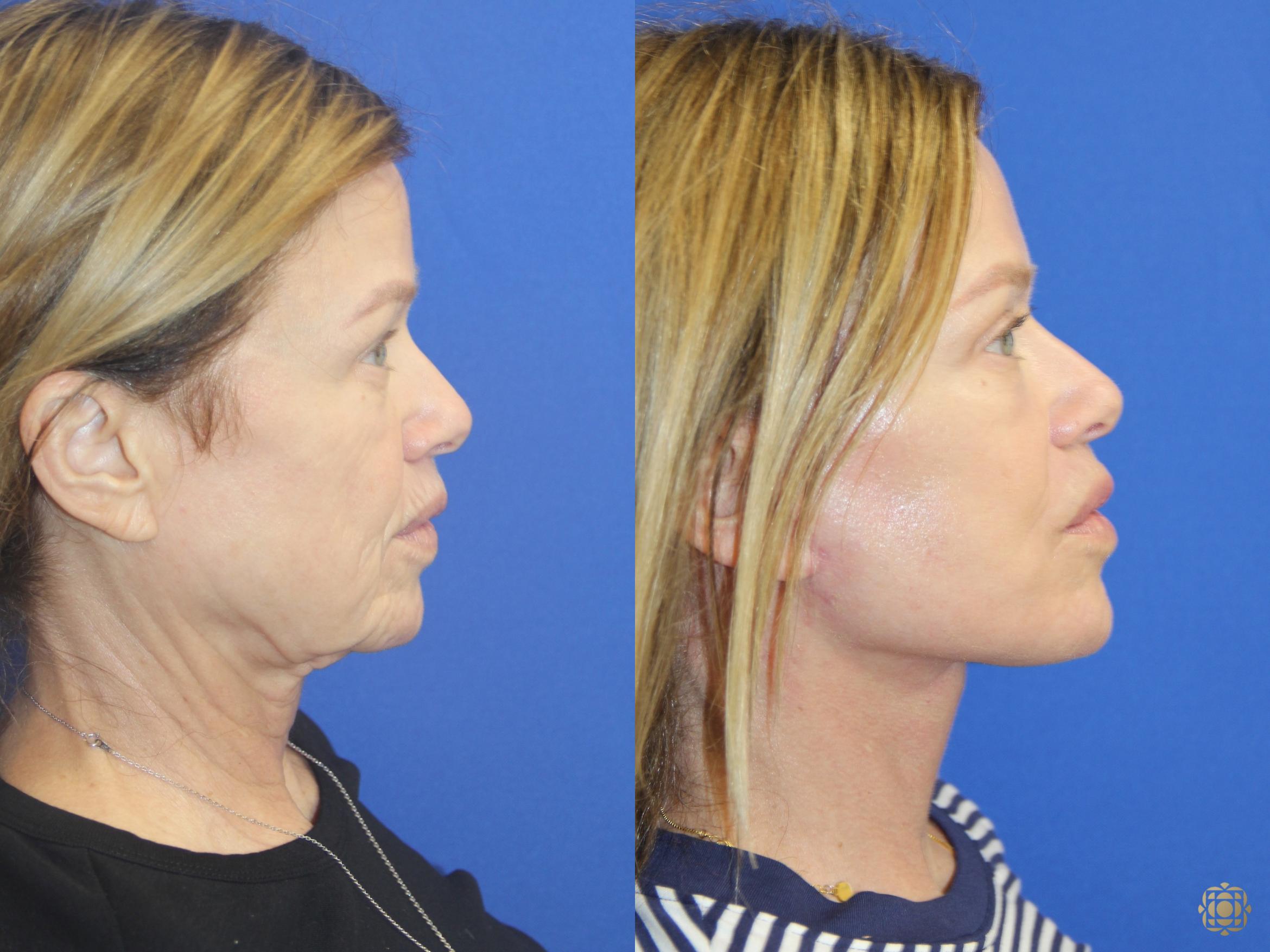 Before & After Facial Fat Grafting Case 416 Right Side View in Newport Beach, CA