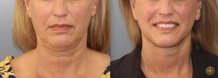 Before & After Face & Neck Lift Case 102 View #1 View in Newport Beach, CA