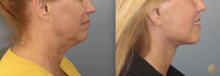 Before & After Face & Neck Lift Case 102 View #2 View in Newport Beach, CA