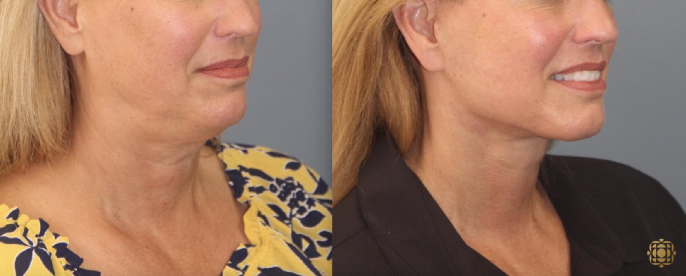 Before & After Face & Neck Lift Case 102 View #3 View in Newport Beach, CA