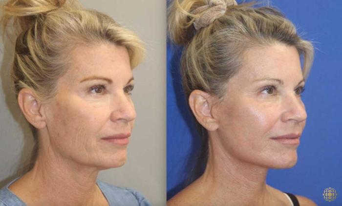 Before & After Face & Neck Lift Case 103 Right Oblique View in Newport Beach, CA
