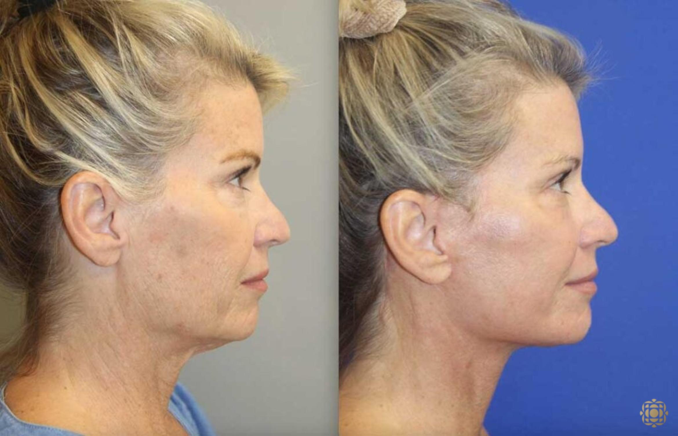 Before & After Face & Neck Lift Case 103 Right Side View in Newport Beach, CA