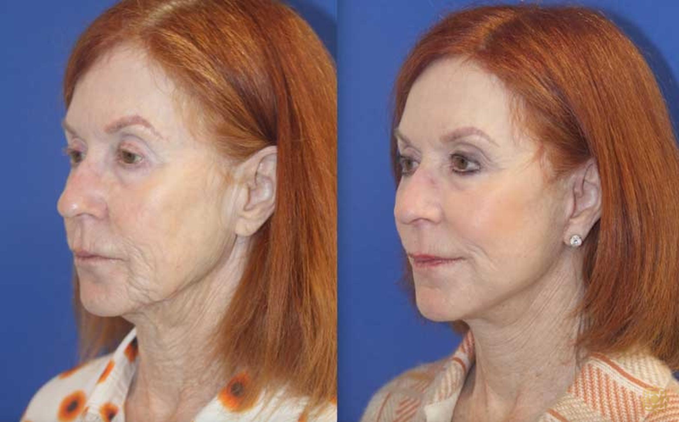 Before & After Face & Neck Lift Case 106 Left Oblique View in Newport Beach, CA