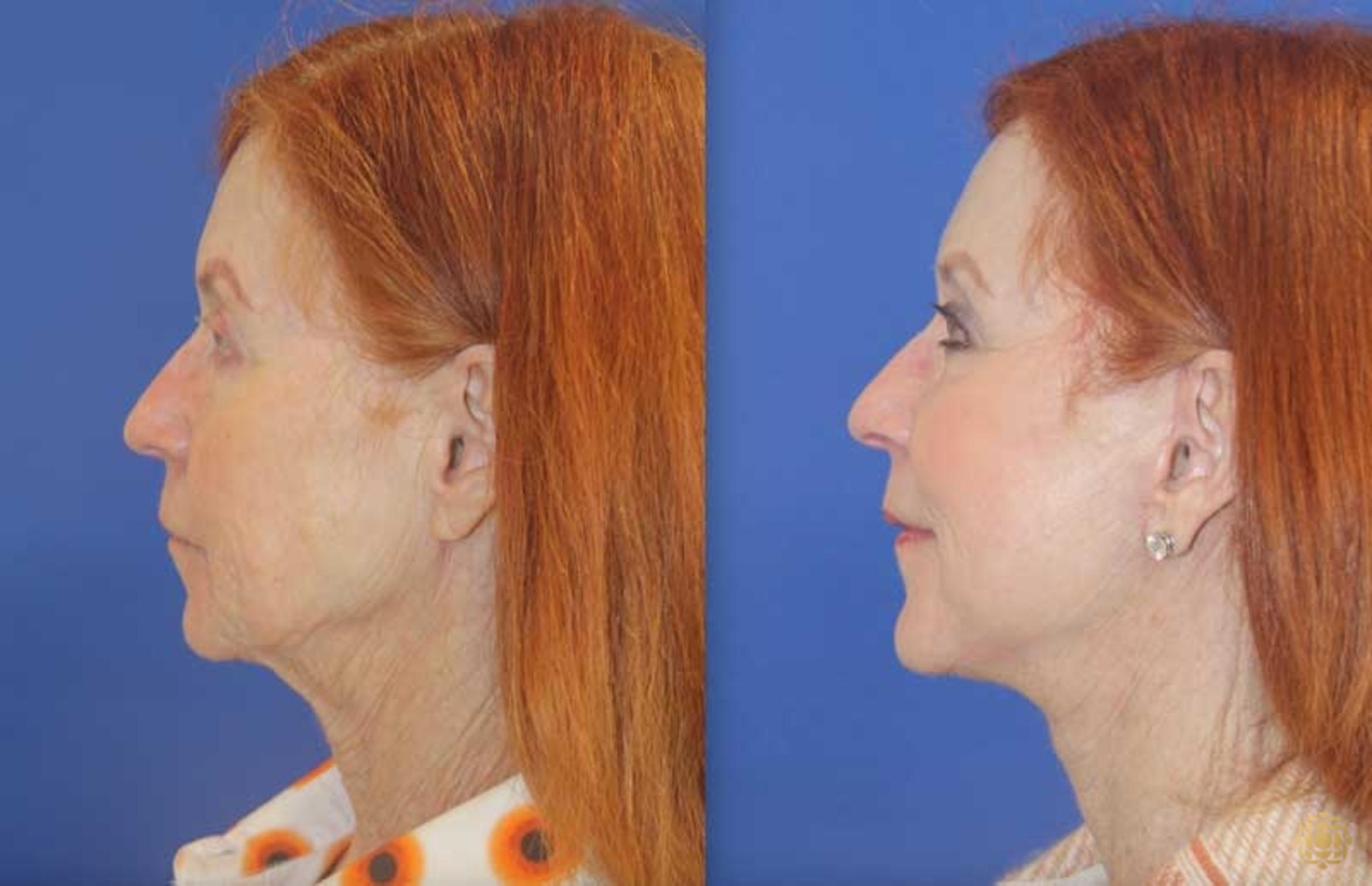 Before & After Face & Neck Lift Case 106 Left Side View in Newport Beach, CA