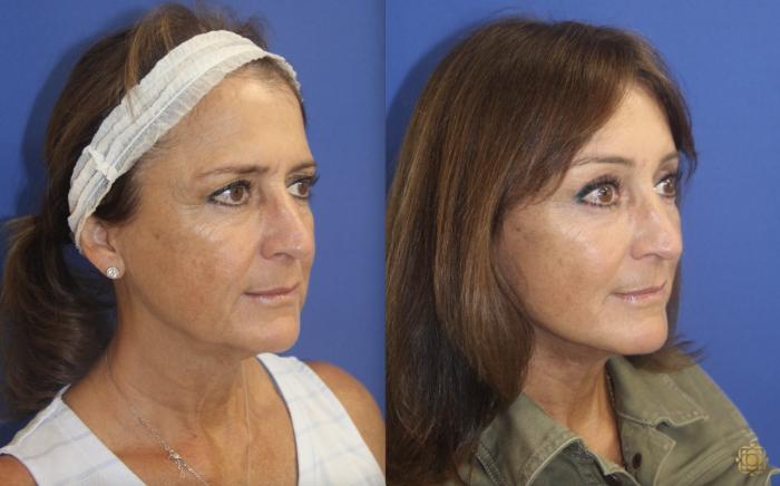 Before & After Face & Neck Lift Case 141 Right Oblique View in Newport Beach, CA