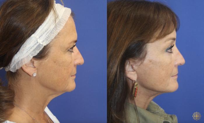 Before & After Face & Neck Lift Case 141 Right Side View in Newport Beach, CA