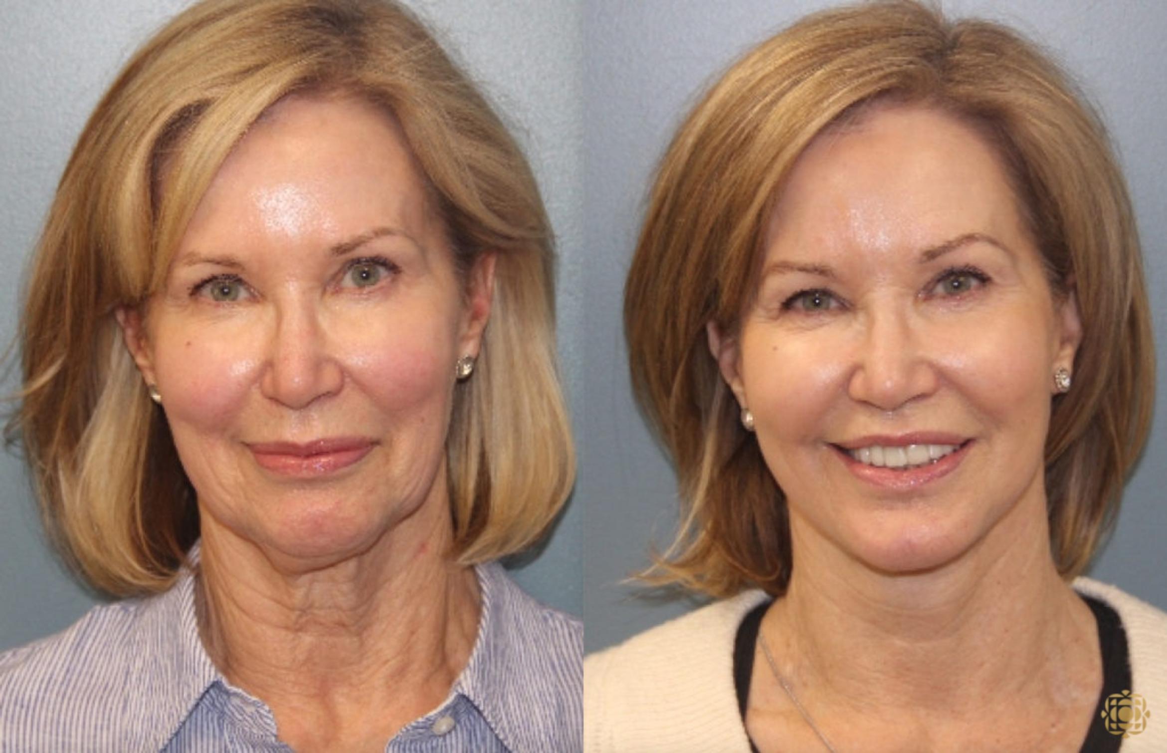 Before & After Face & Neck Lift Case 33 Front View in Newport Beach, CA