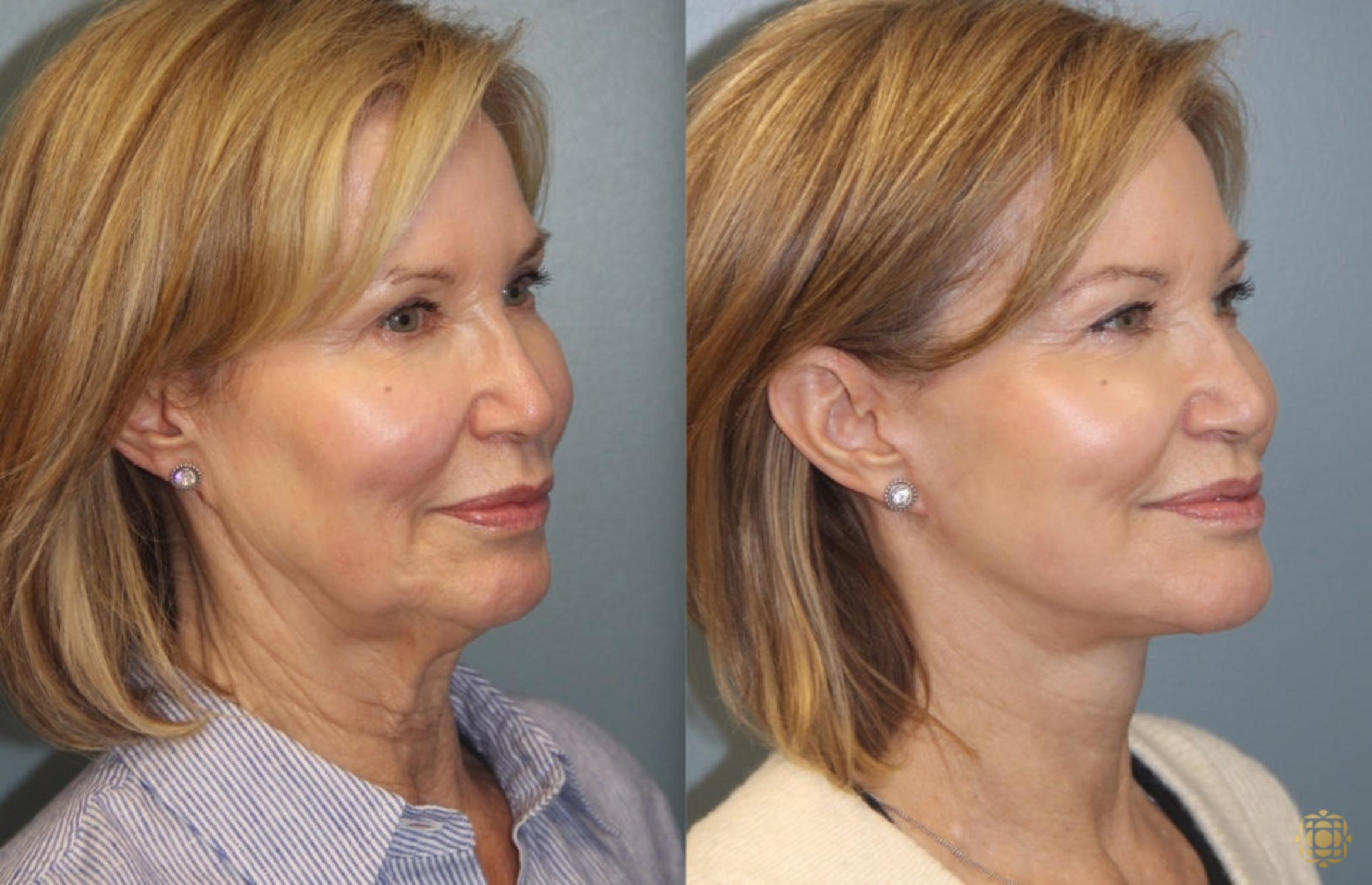 Before & After Face & Neck Lift Case 33 Right Oblique View in Newport Beach, CA