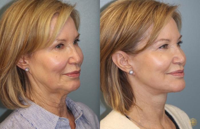 Before & After Face & Neck Lift Case 33 Right Oblique View in Newport Beach, CA