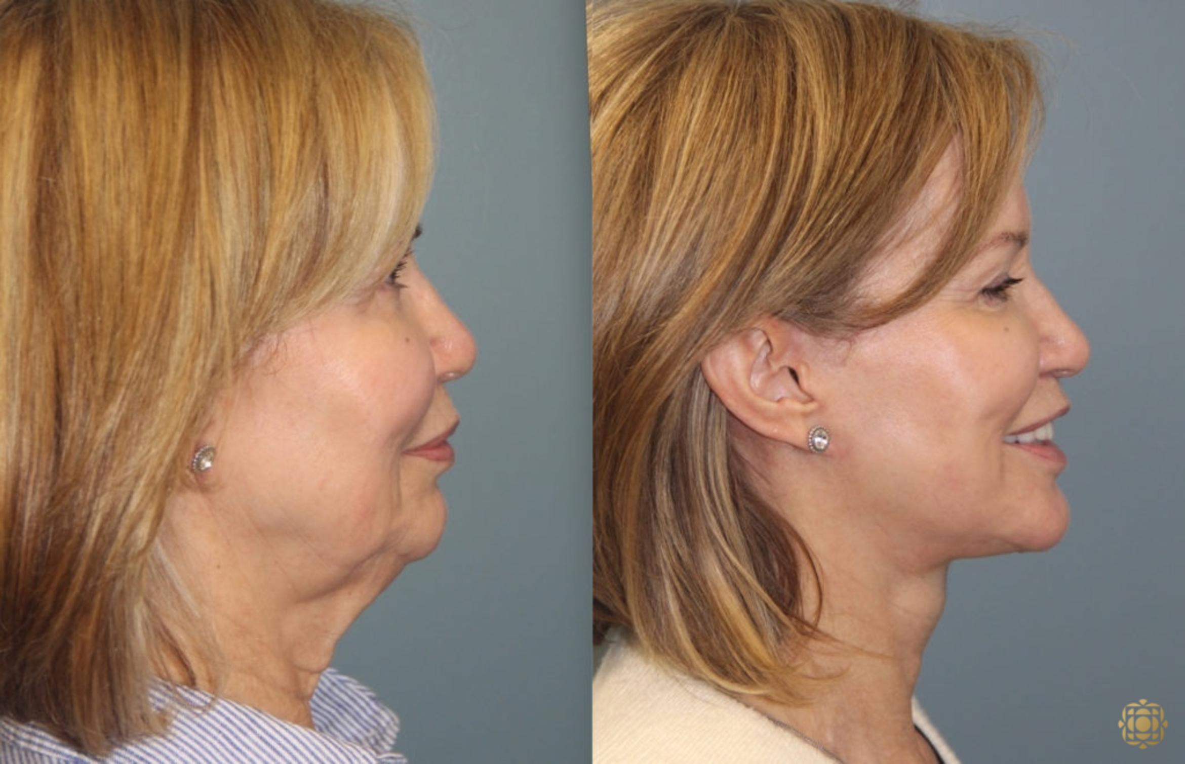 Before & After Face & Neck Lift Case 33 Right Side View in Newport Beach, CA