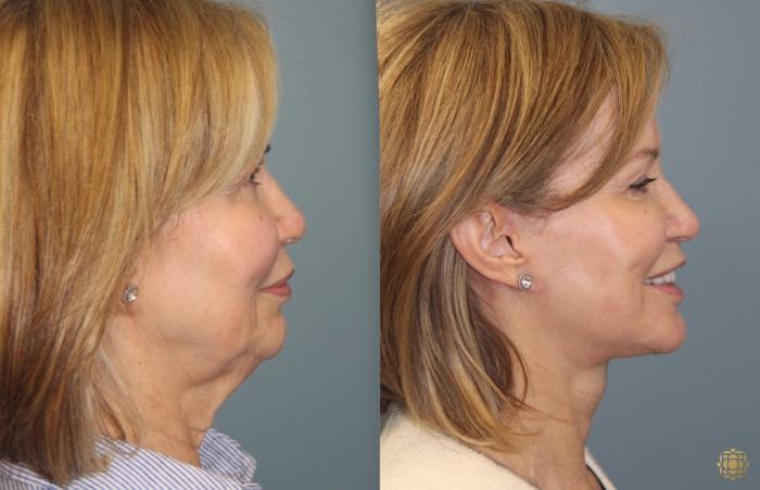 Before & After Face & Neck Lift Case 33 Right Side View in Newport Beach, CA