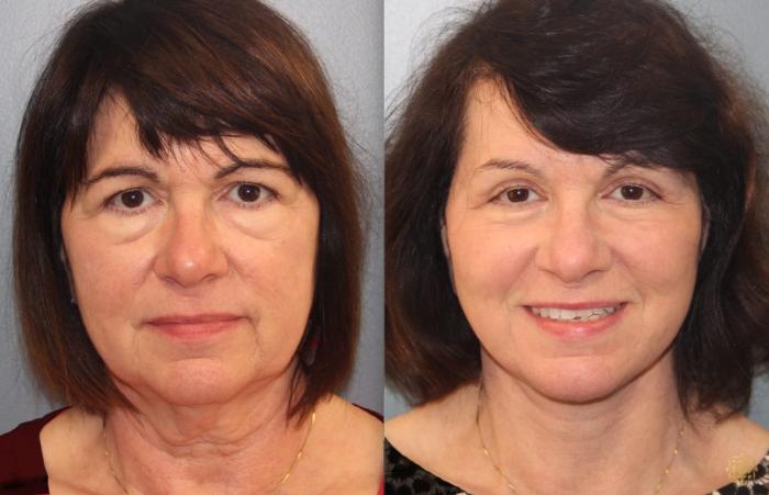 Before & After Blepharoplasty Case 36 Front View in Newport Beach, CA