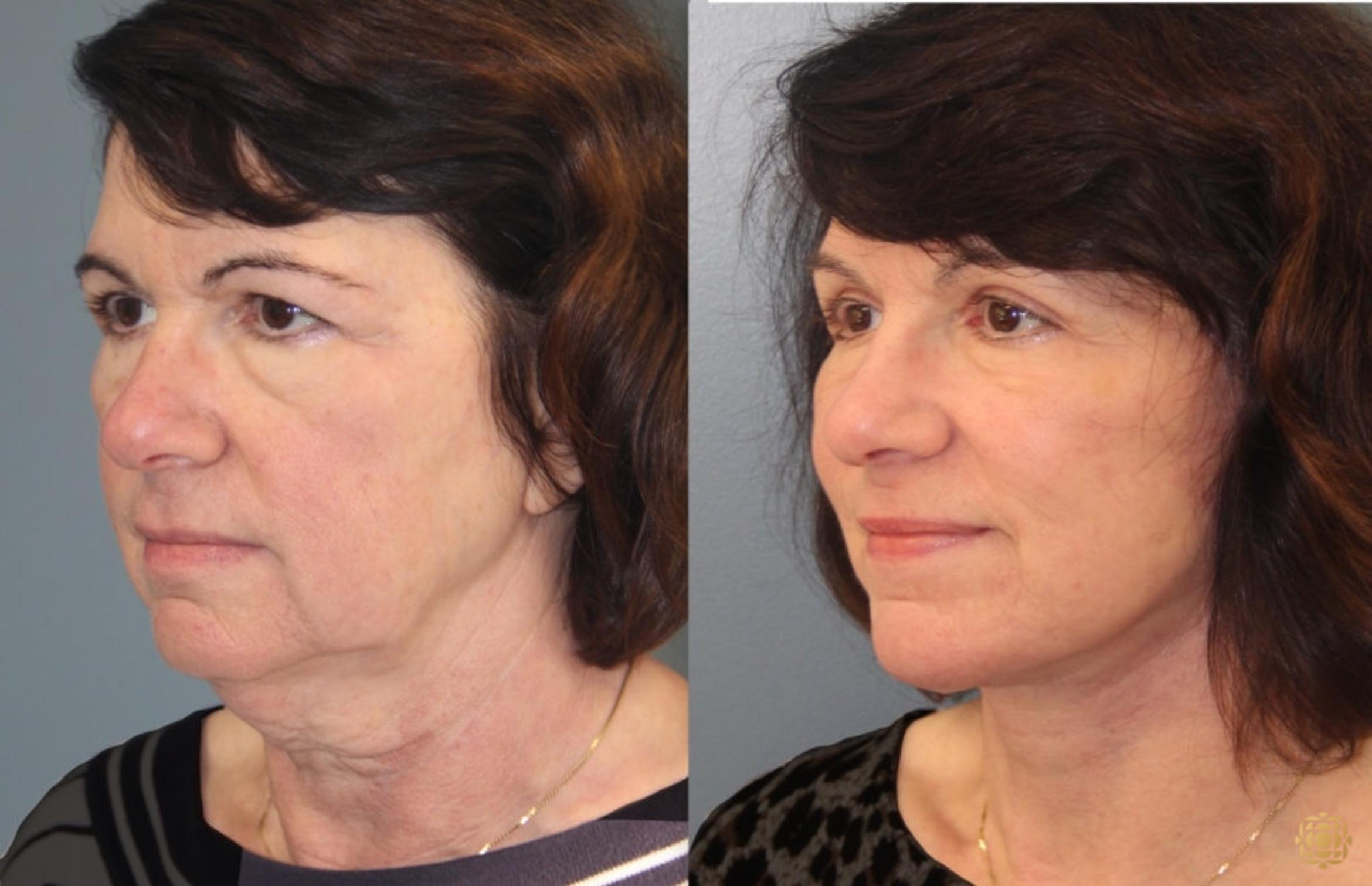 Before & After Blepharoplasty Case 36 Left Oblique View in Newport Beach, CA