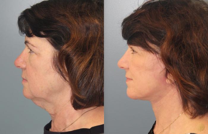 Before & After Blepharoplasty Case 36 Left Side View in Newport Beach, CA