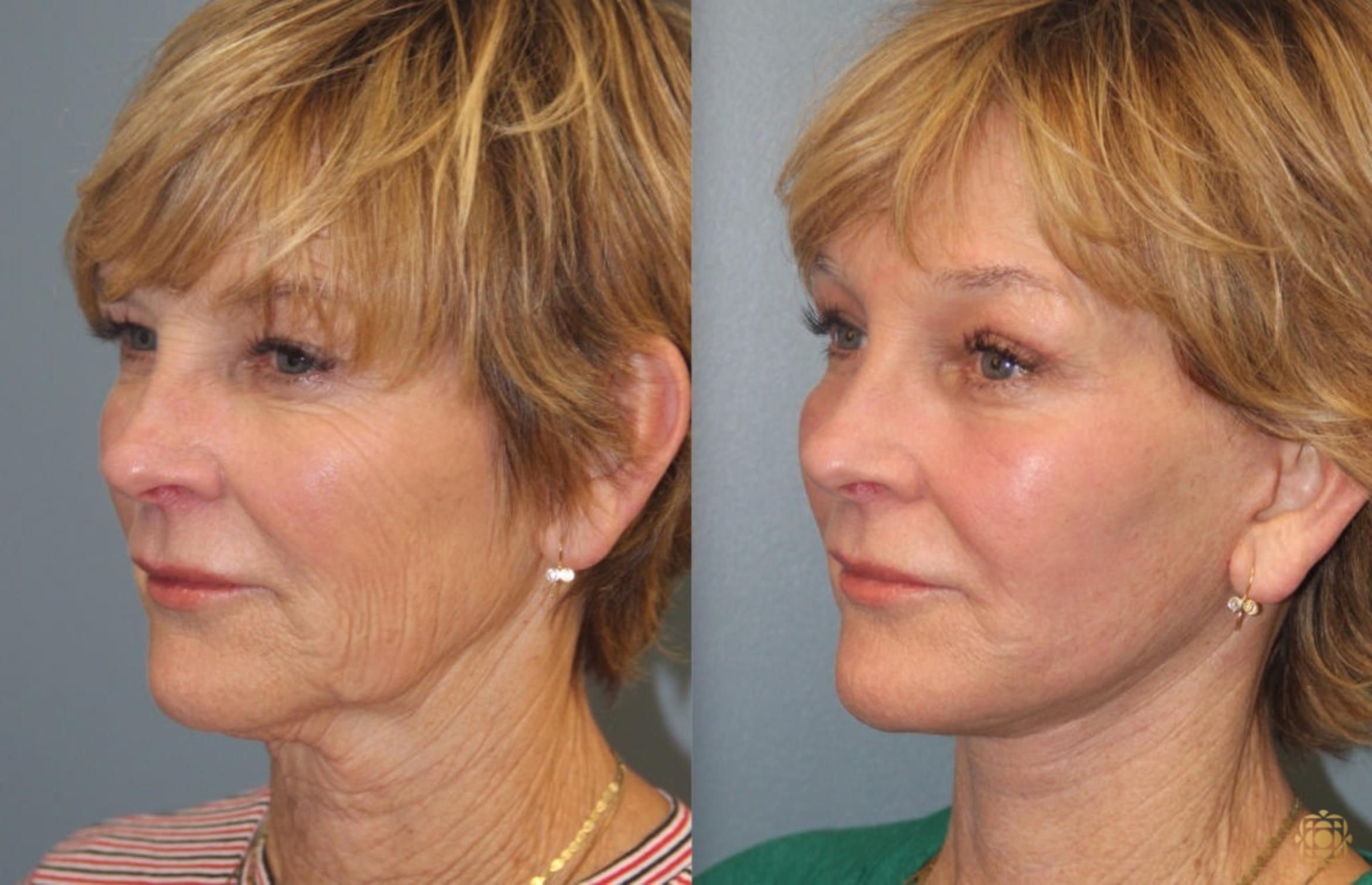 Before & After Fractional CO2 Laser Skin Resurfacing Case 39 Left Oblique View in Newport Beach, CA