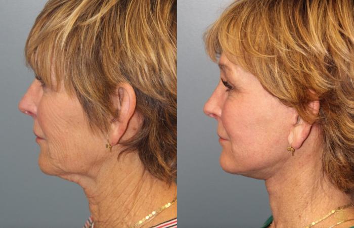 Before & After Fractional CO2 Laser Skin Resurfacing Case 39 Left Side View in Newport Beach, CA