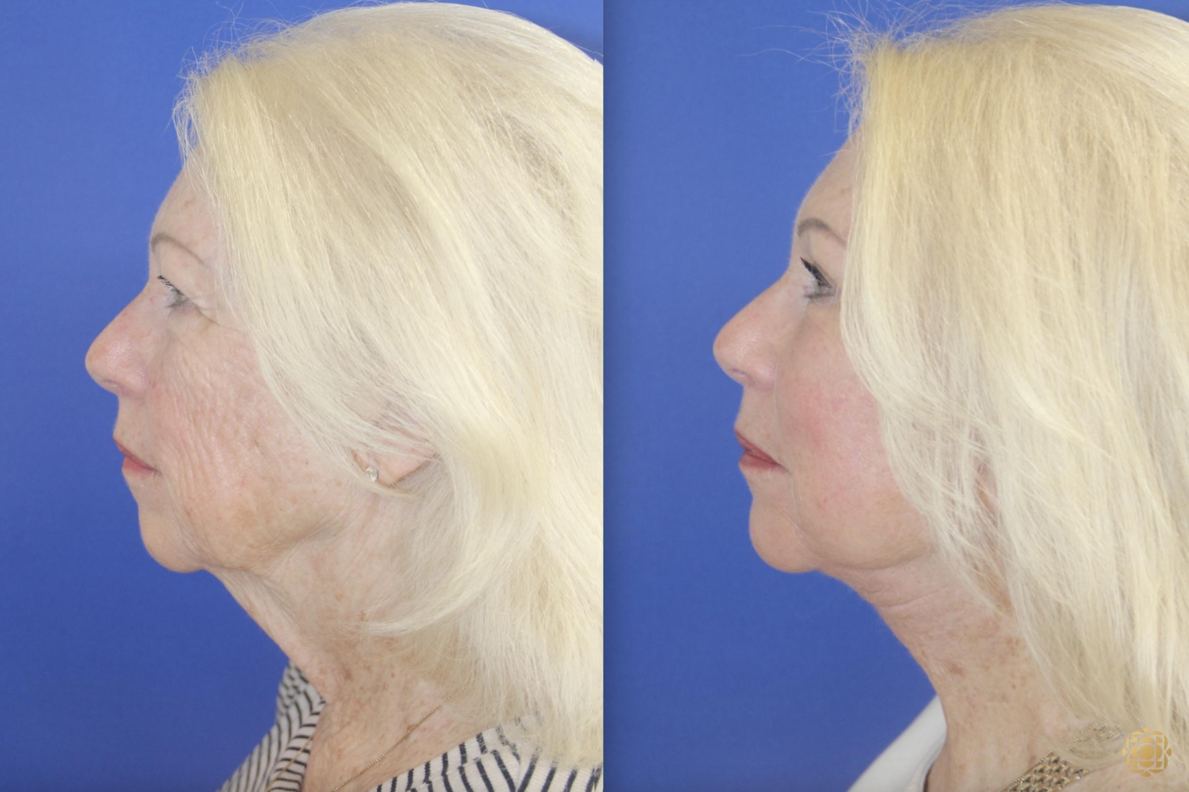 Before & After Fractional CO2 Laser Skin Resurfacing Case 396 Left Side View in Newport Beach, CA