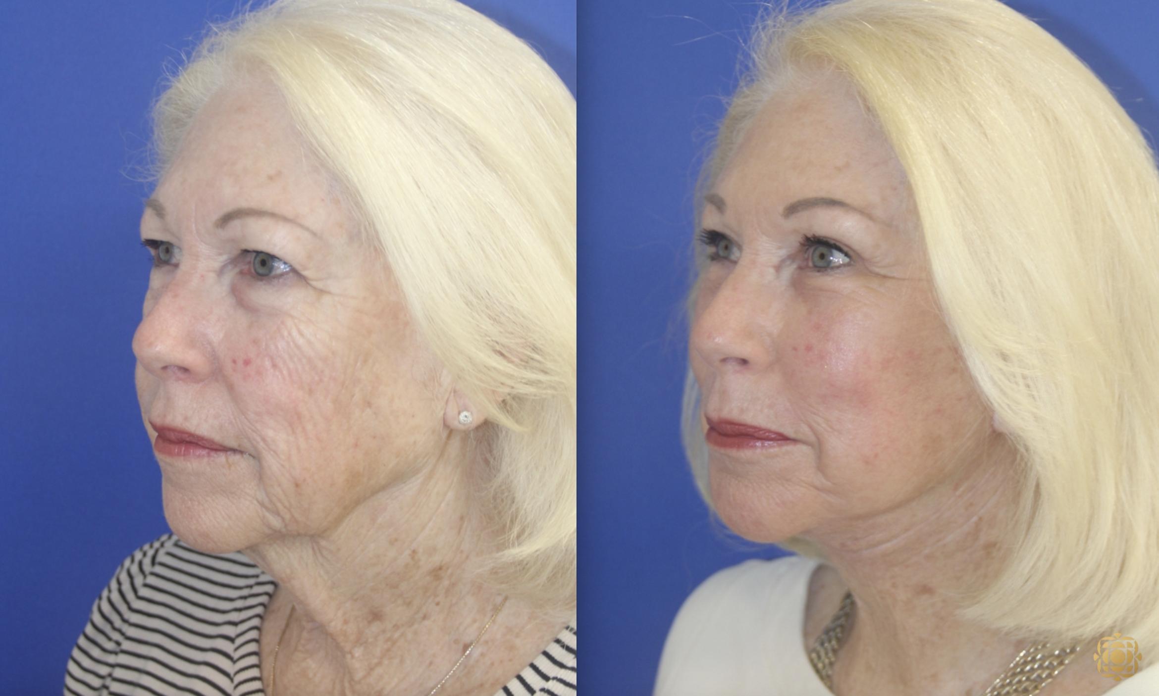 Before & After Fractional CO2 Laser Skin Resurfacing Case 396 Right Oblique View in Newport Beach, CA