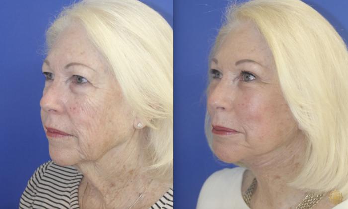 Before & After Fractional CO2 Laser Skin Resurfacing Case 396 Right Oblique View in Newport Beach, CA