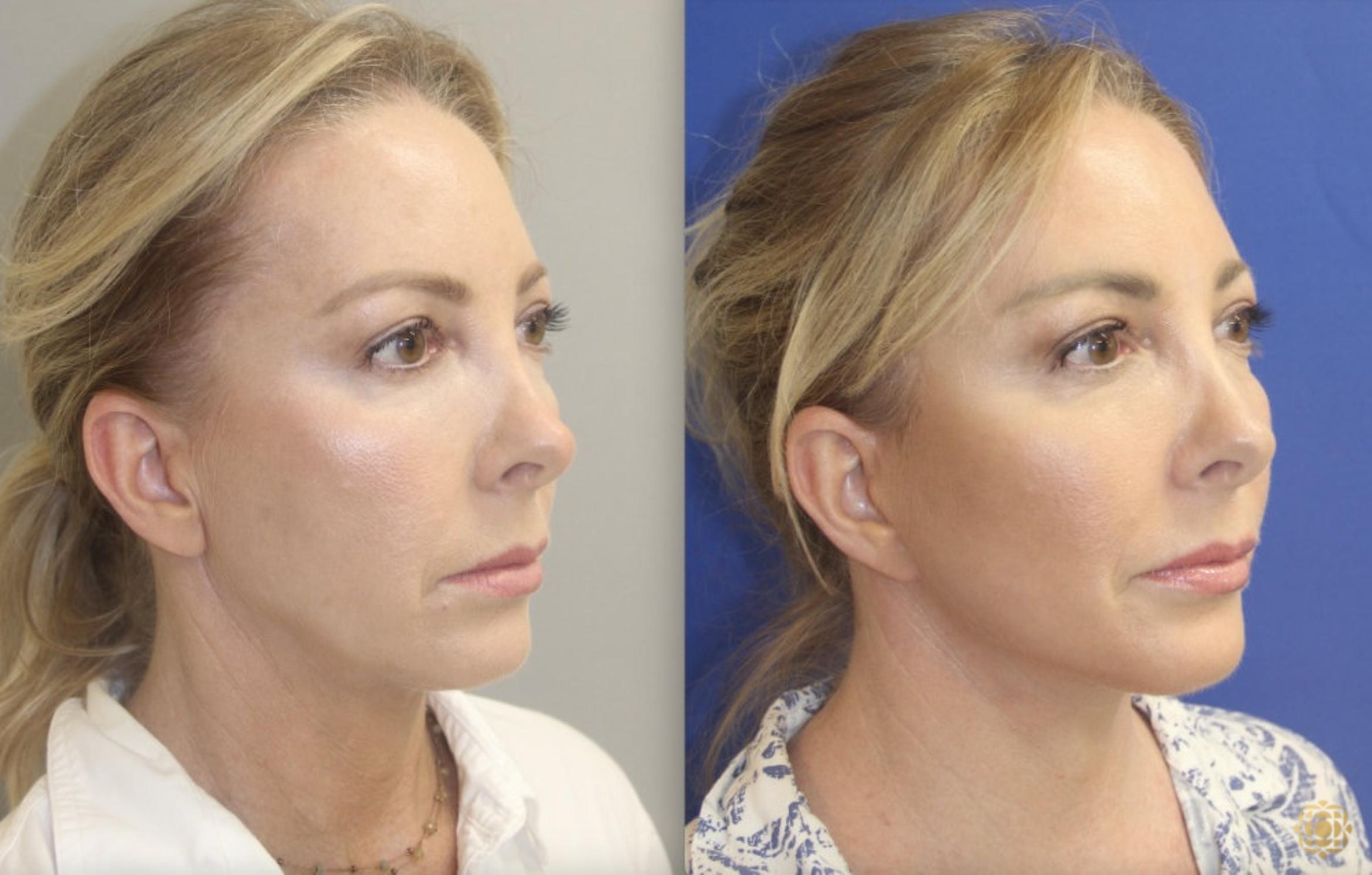 Before & After Fractional CO2 Laser Skin Resurfacing Case 398 Right Oblique View in Newport Beach, CA