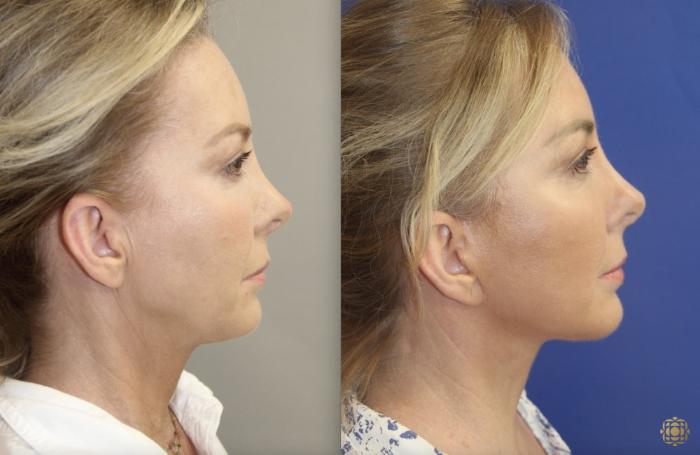 Before & After Fractional CO2 Laser Skin Resurfacing Case 398 Right Side View in Newport Beach, CA