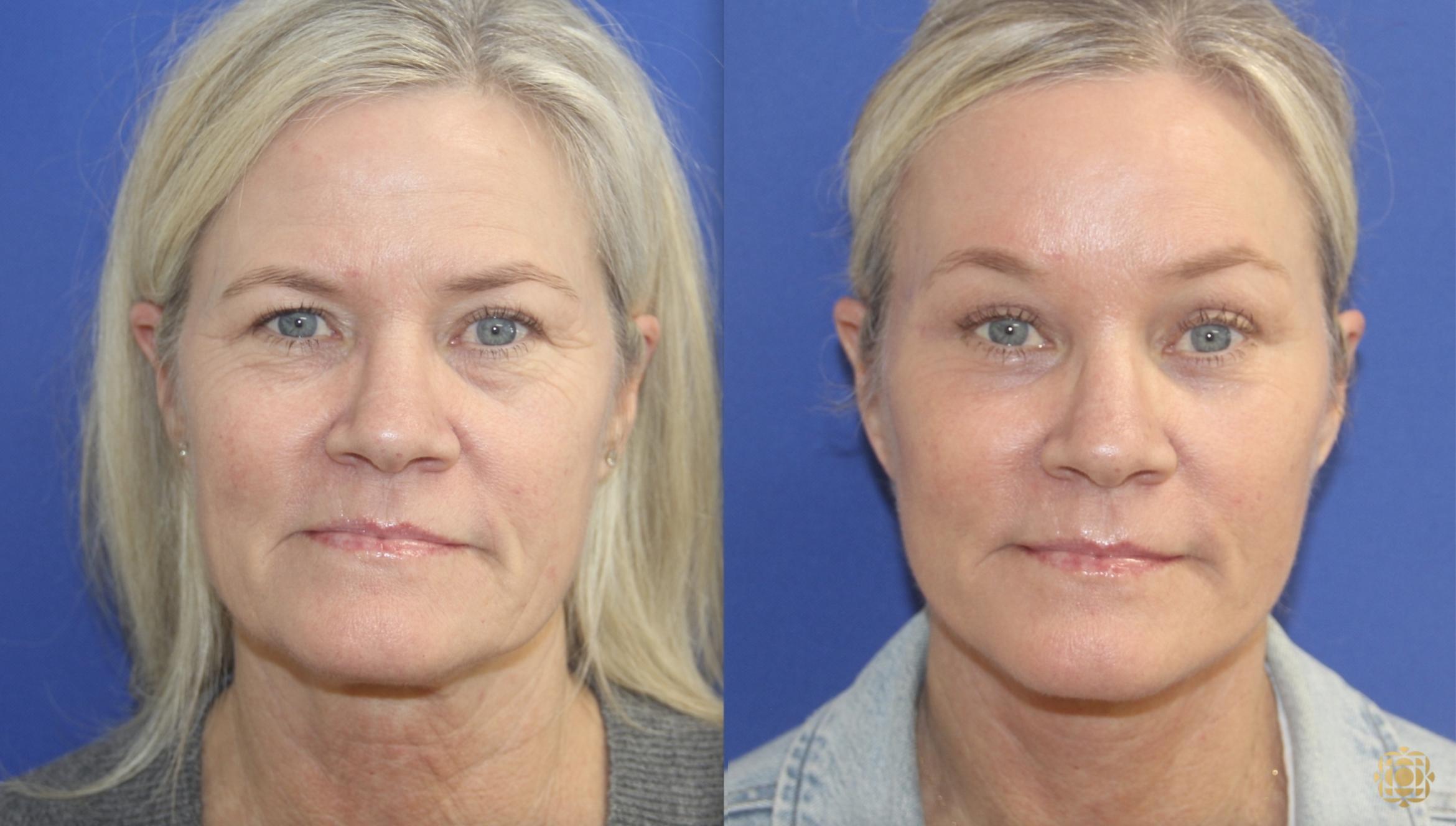 Before & After Face & Neck Lift Case 401 Front View in Newport Beach, CA