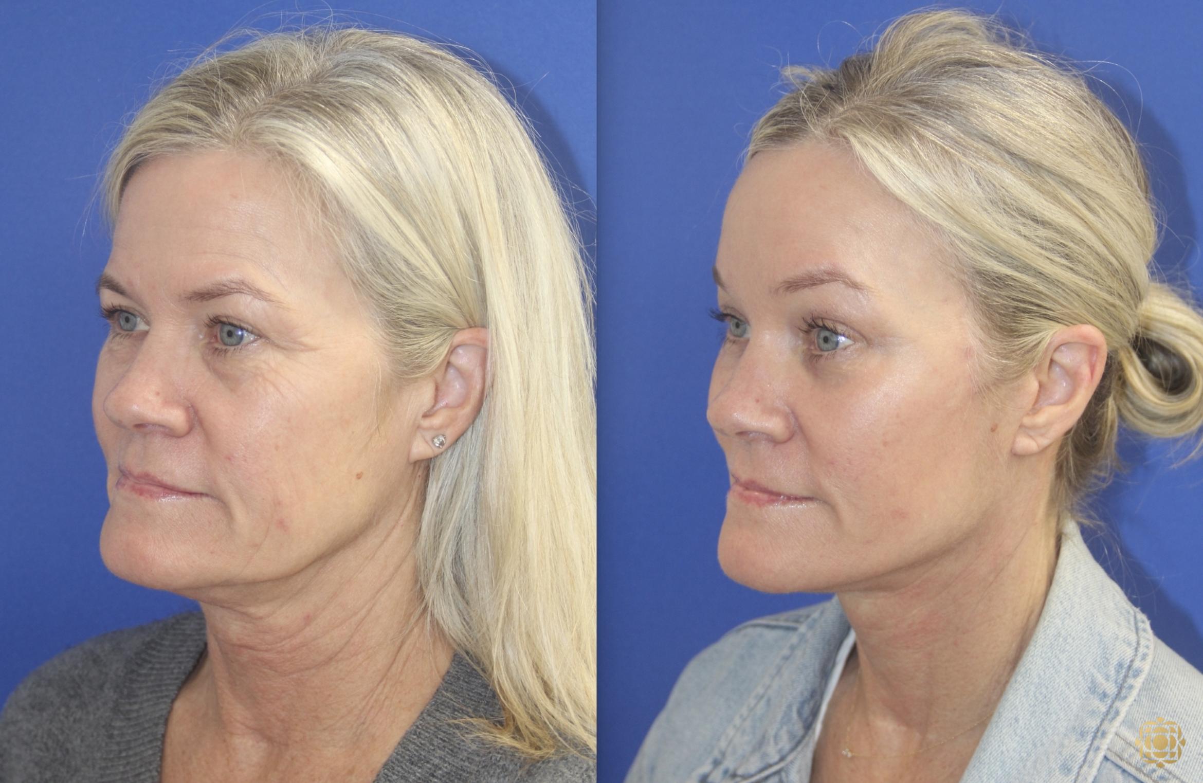 Before & After Face & Neck Lift Case 401 Left Oblique View in Newport Beach, CA