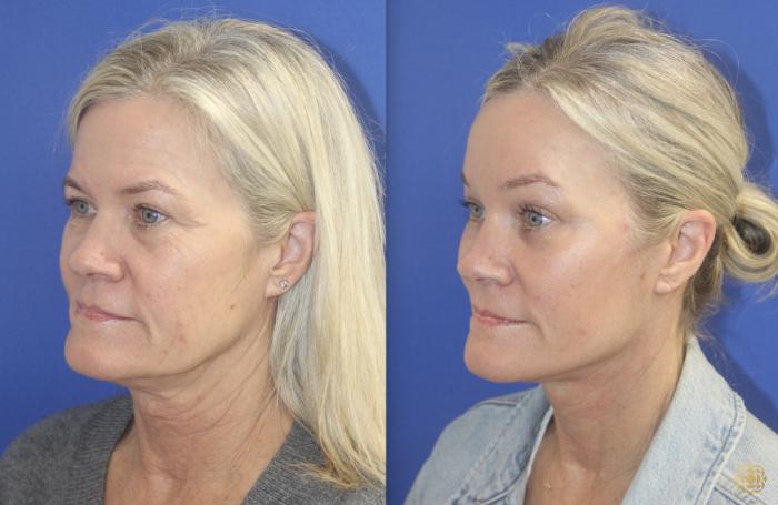 Before & After Face & Neck Lift Case 401 Left Oblique View in Newport Beach, CA