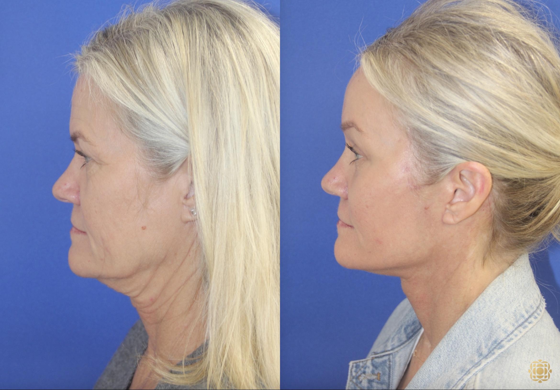 Lower Face and Neck Lift; Browlift; Lower Blepharoplasty with Fat Transfer; Fractional CO2 Laser - Periocular