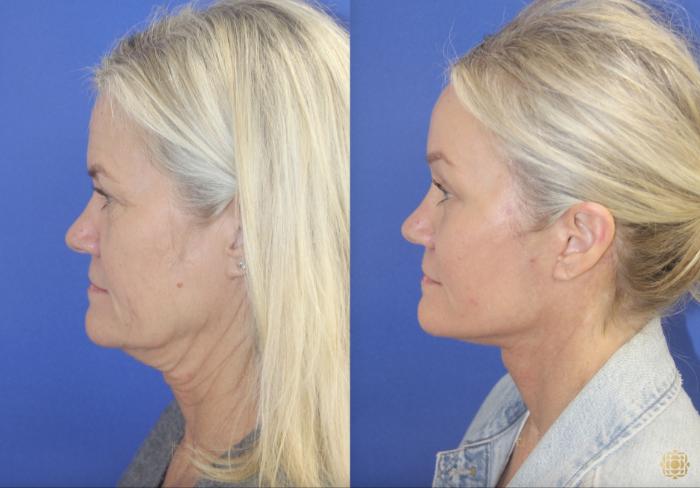 Lower Face and Neck Lift; Browlift; Lower Blepharoplasty with Fat Transfer; Fractional CO2 Laser - Periocular
