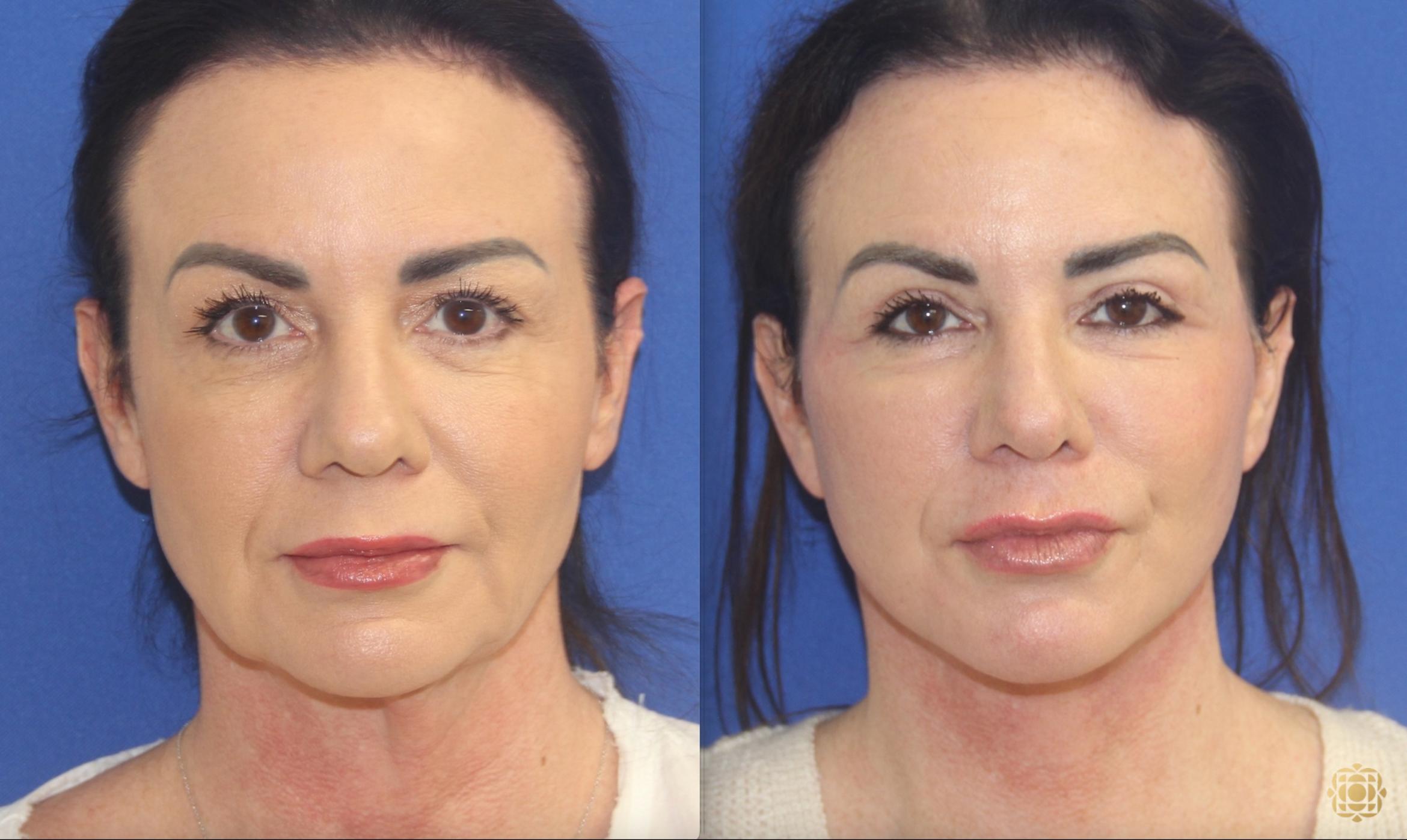 Lower Face and Neck Lift; Upper Blepharoplasty; Fractional CO2 Laser - Periocular	