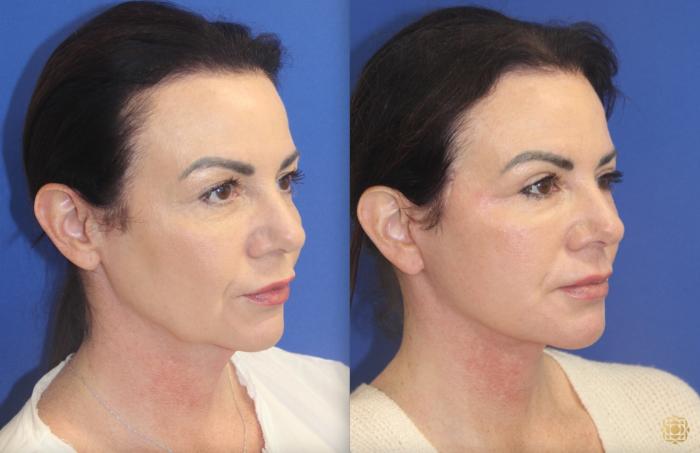 Before & After Face & Neck Lift Case 402 Right Oblique View in Newport Beach, CA