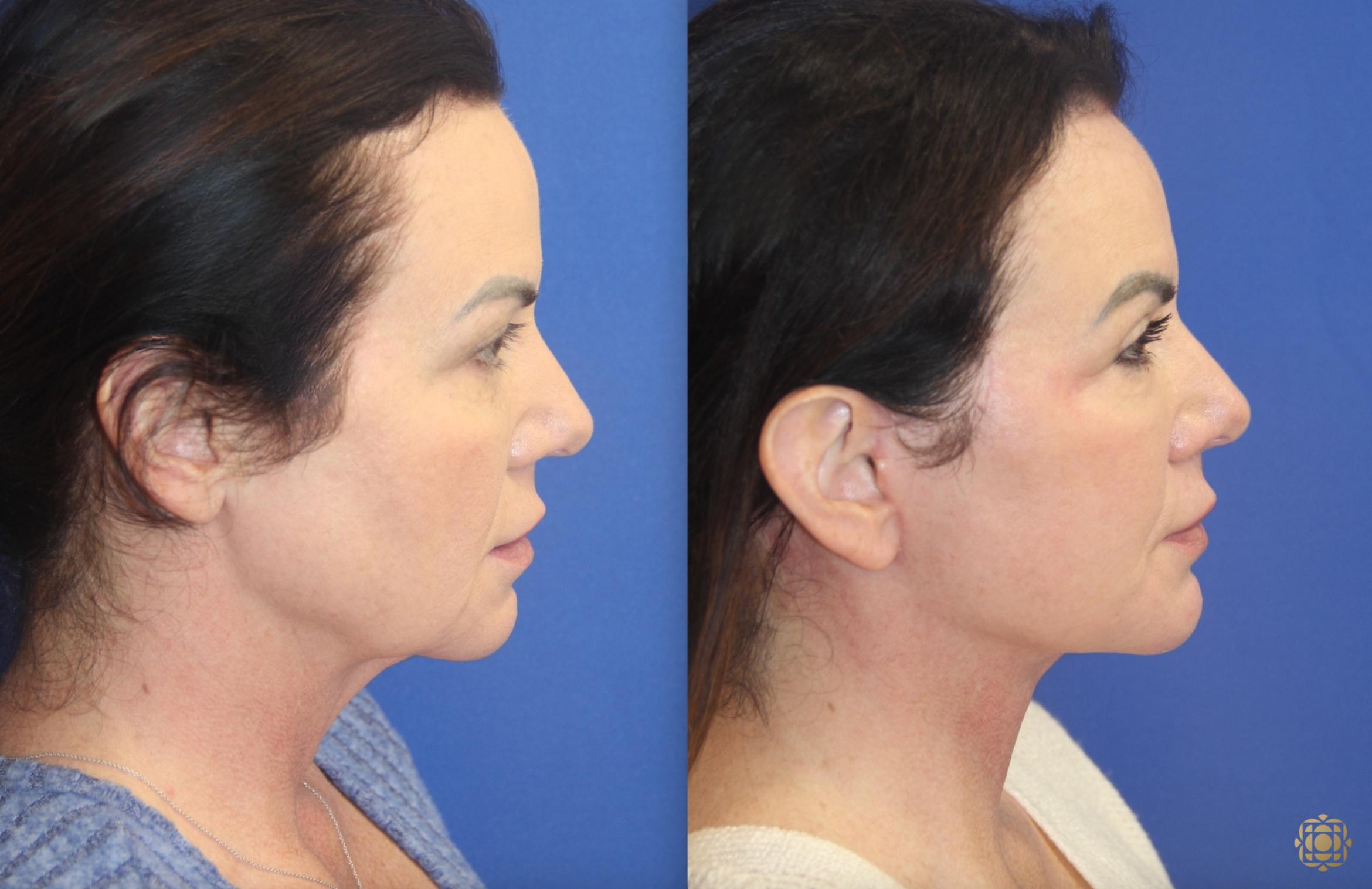 Before & After Face & Neck Lift Case 402 Right Side View in Newport Beach, CA