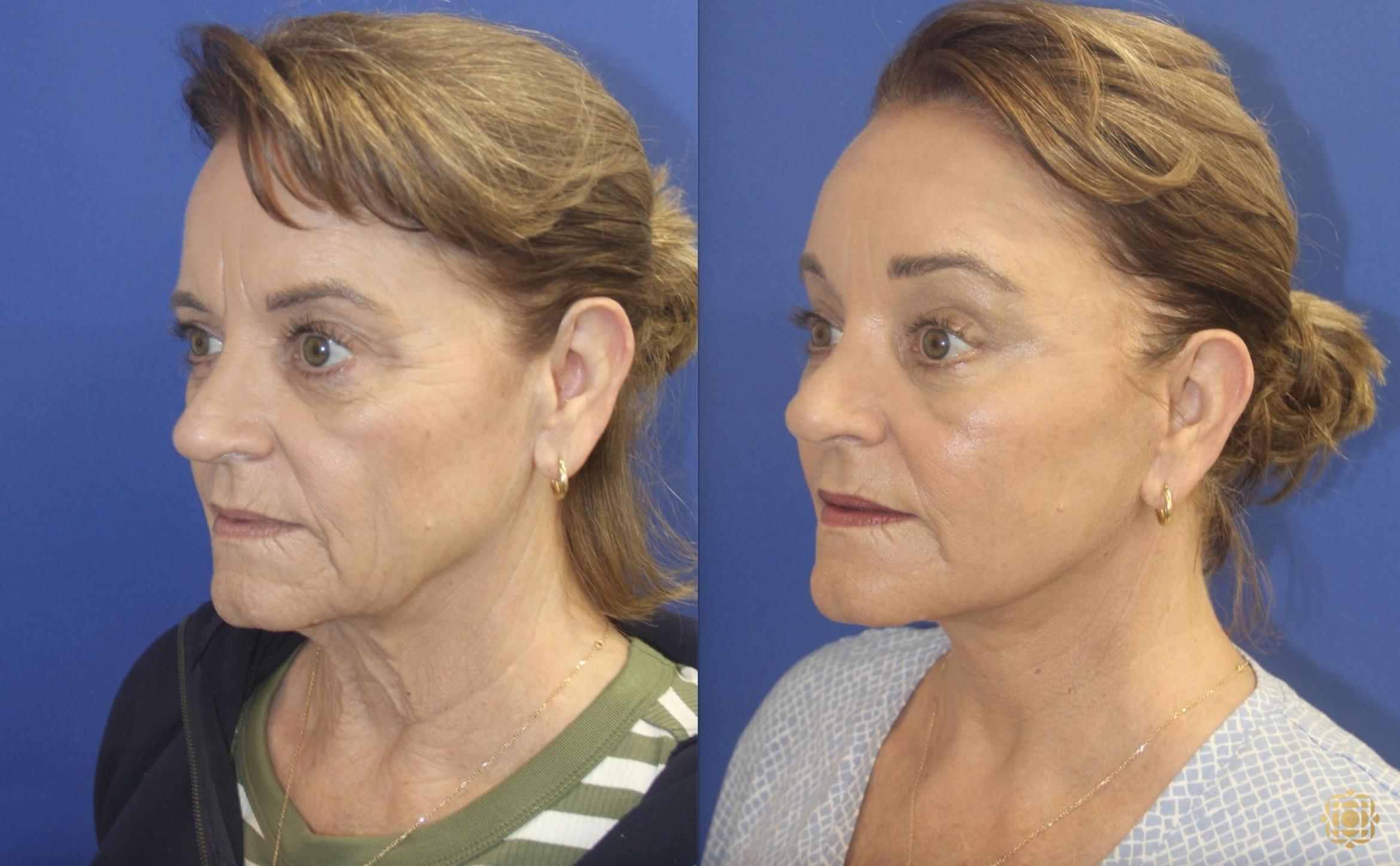 Before & After Fractional CO2 Laser Skin Resurfacing Case 403 Left Oblique View in Newport Beach, CA