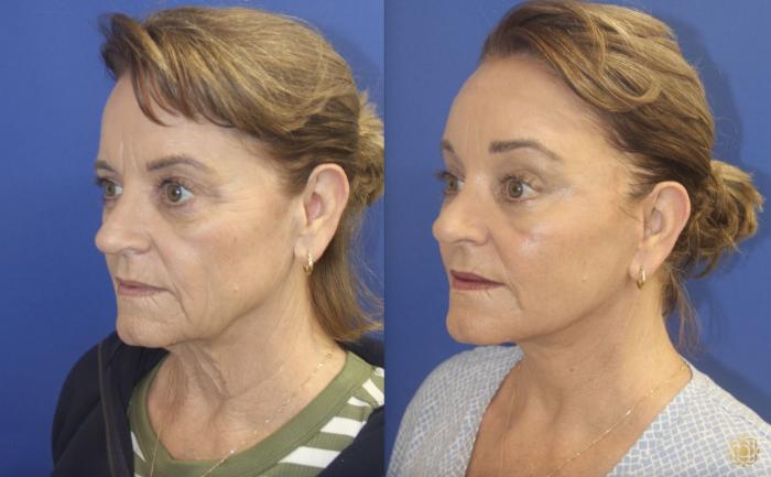 Before & After Fractional CO2 Laser Skin Resurfacing Case 403 Left Oblique View in Newport Beach, CA