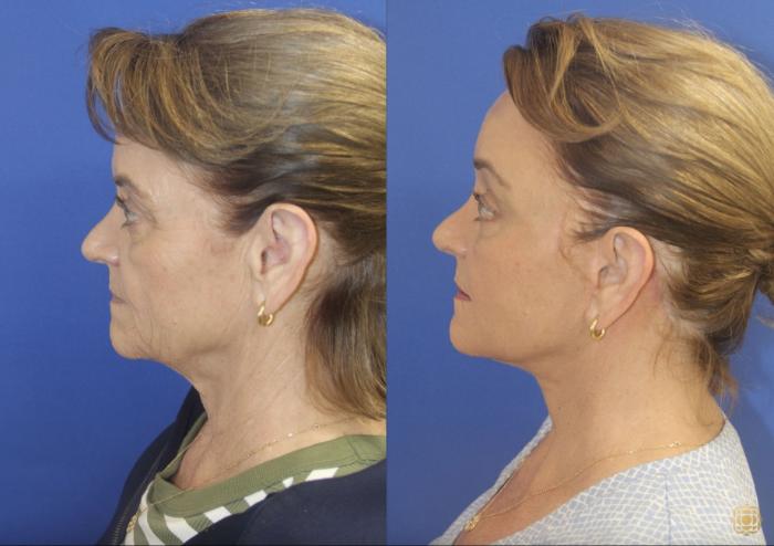 Before & After Fractional CO2 Laser Skin Resurfacing Case 403 Left Side View in Newport Beach, CA
