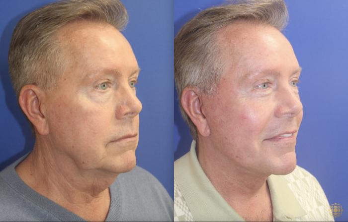 Before & After Face & Neck Lift Case 404 Right Oblique View in Newport Beach, CA