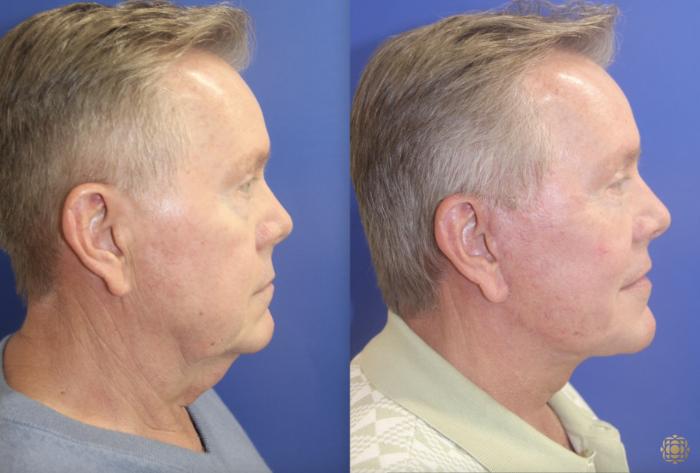 Before & After Face & Neck Lift Case 404 Right Side View in Newport Beach, CA