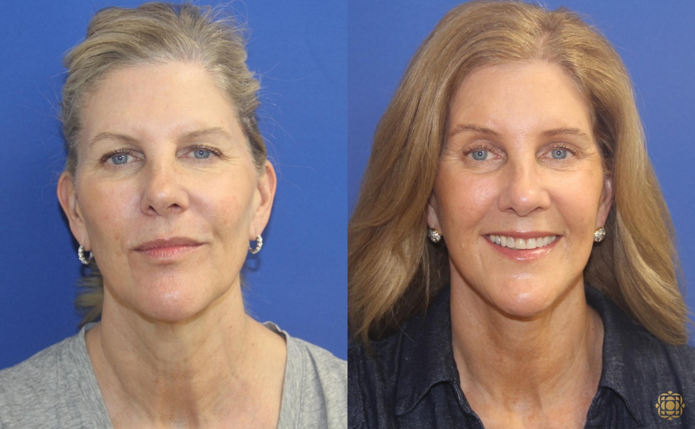Before & After Face & Neck Lift Case 405 Front View in Newport Beach, CA