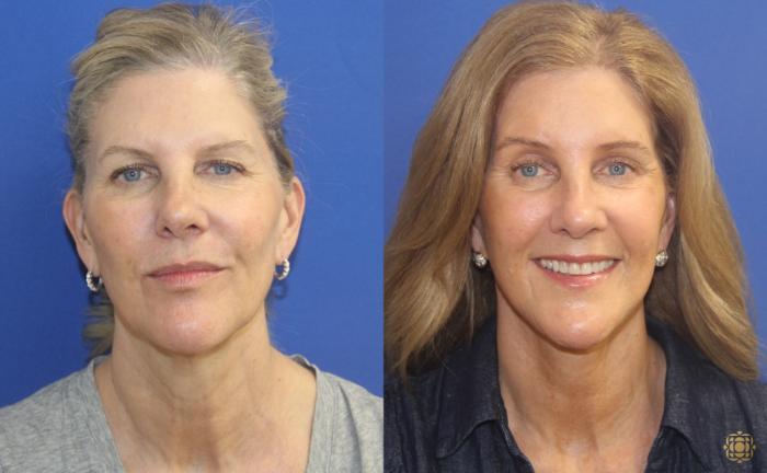 Before & After Dr. Daines Signature Facelift Case 405 Front View in Newport Beach, CA