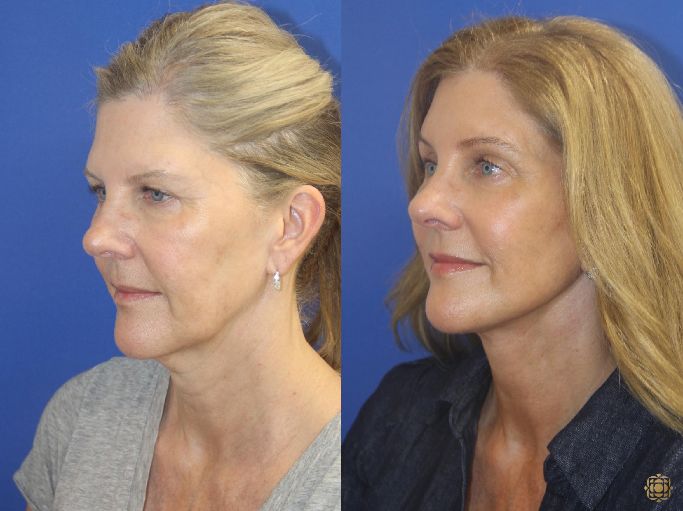 Before & After Face & Neck Lift Case 405 Left Oblique View in Newport Beach, CA