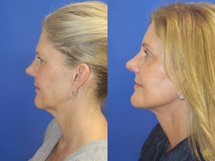 Before & After Face & Neck Lift Case 405 Left Side View in Newport Beach, CA