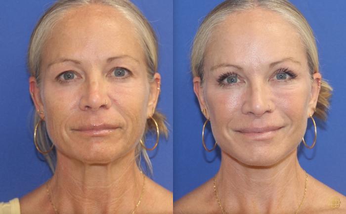 Before & After Dr. Daines Signature Facelift Case 406 Front View in Newport Beach, CA