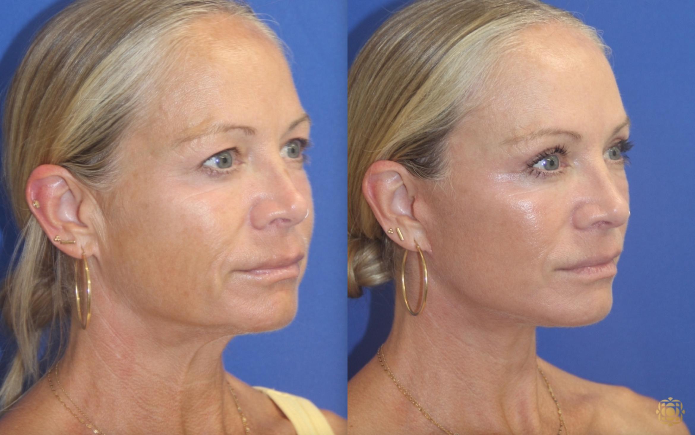 Before & After Face & Neck Lift Case 406 Right Oblique View in Newport Beach, CA