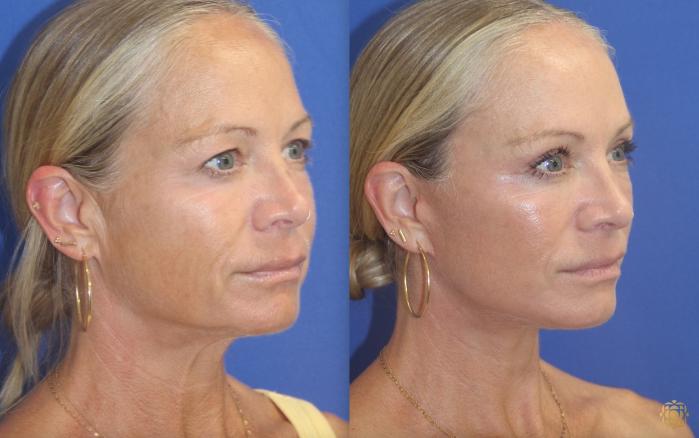 Before & After Face & Neck Lift Case 406 Right Oblique View in Newport Beach, CA