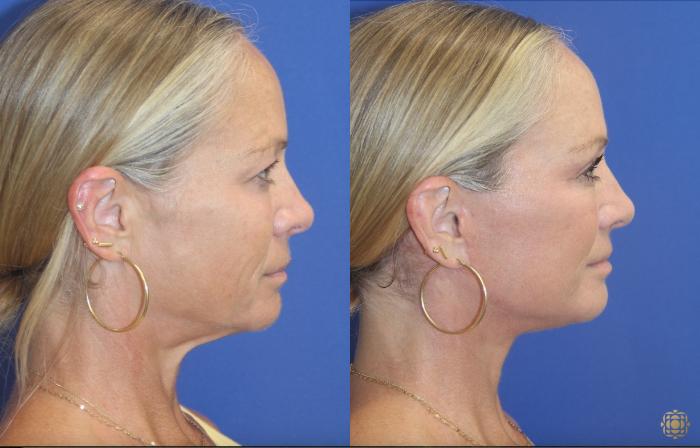 Before & After Face & Neck Lift Case 406 Right Side View in Newport Beach, CA